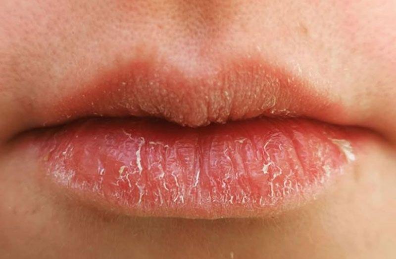 ترک خوردگی گوشه‌‌ی لب‌ها