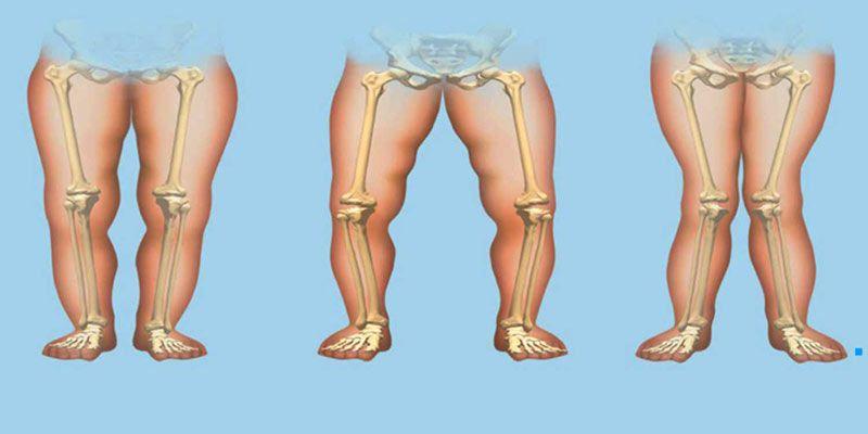 نرمی استخوان