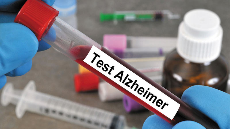 شانس تشخیص بیماری آلزایمر با انجام آزمایش خون