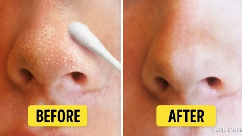 رهایی از جوش های سرسیاه و سرسفید