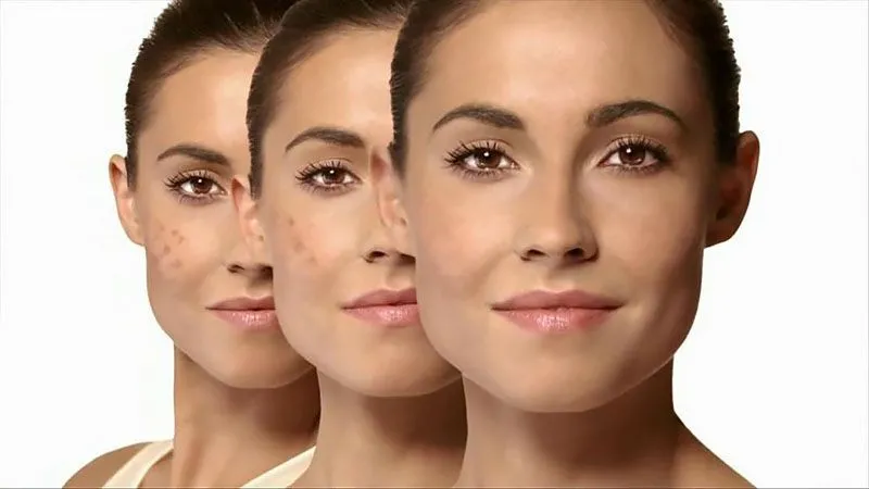 روش‌های سریع درمان جوش‌های صورت 